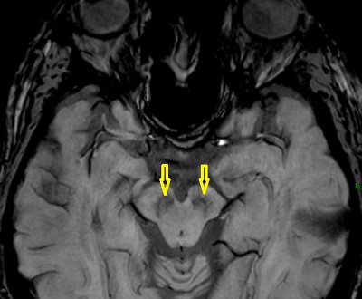 Sárga nyilak mutatják a substantia nigra helyzetét a középagyban az SWI típusú MR felvételen, ahol a dopamin hiánya a Parkinson-kór kialakulásához vezet